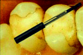 Graphical abstract: Application of HS-SPME in the determination of potentially toxic organic compounds emitted from resin-based dental materials