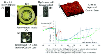 Graphical abstract: Co-delivery of timolol and hyaluronic acid from semi-circular ring-implanted contact lenses for the treatment of glaucoma: in vitro and in vivo evaluation