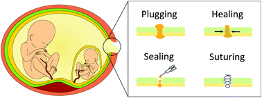 Graphical abstract: Biomaterial-based treatments for the prevention of preterm birth after iatrogenic rupture of the fetal membranes